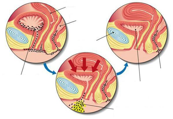 batteri nella vescica con cistite