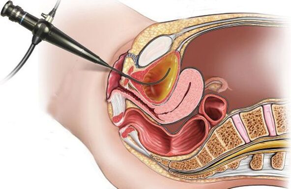 cistoscopia per cistite