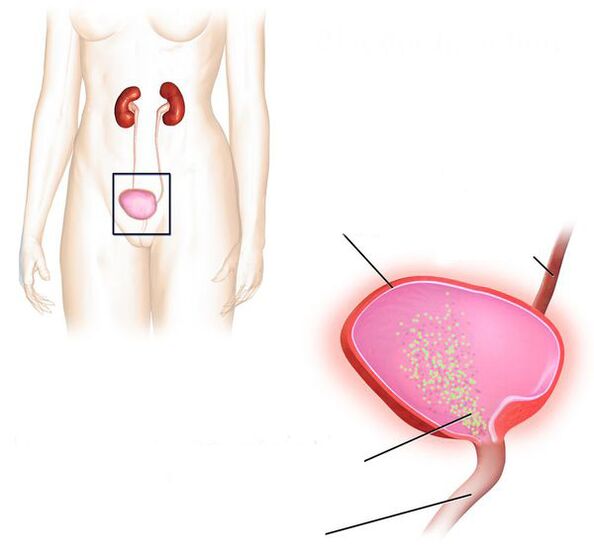 infiammazione della vescica